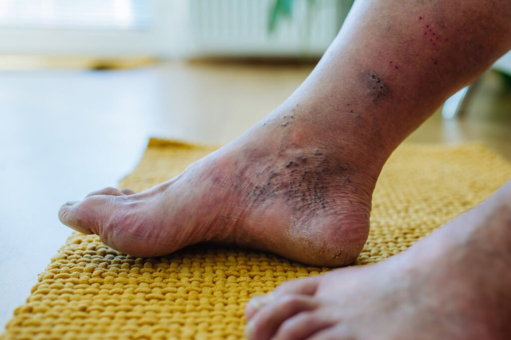 How to Heal Diabetic Foot Fast