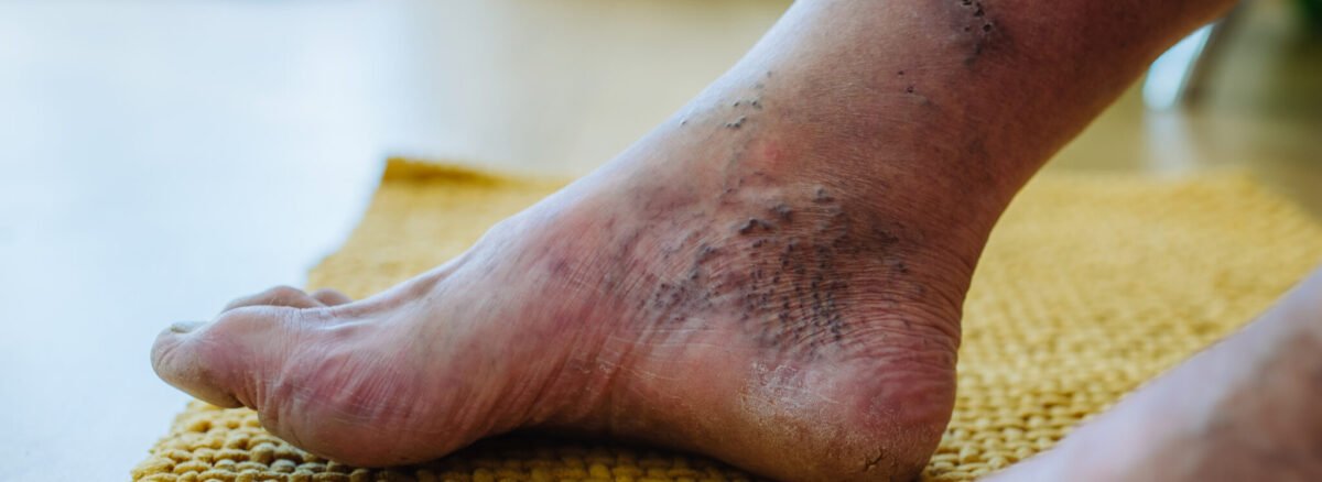 How to Heal Diabetic Foot Fast