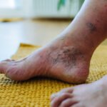 How to Heal Diabetic Foot Fast