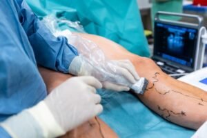 Laser Treatment Safe for Varicose Veins?