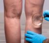 Leg pain