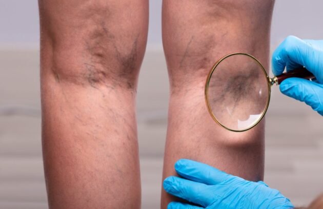 Leg pain