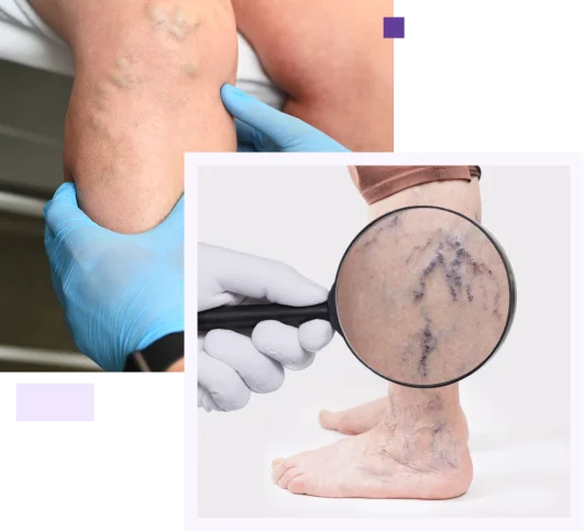 Varicose vein treatment in coimbatore