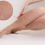 varicose veins treatment