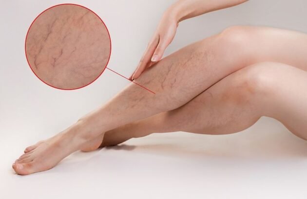 varicose veins treatment