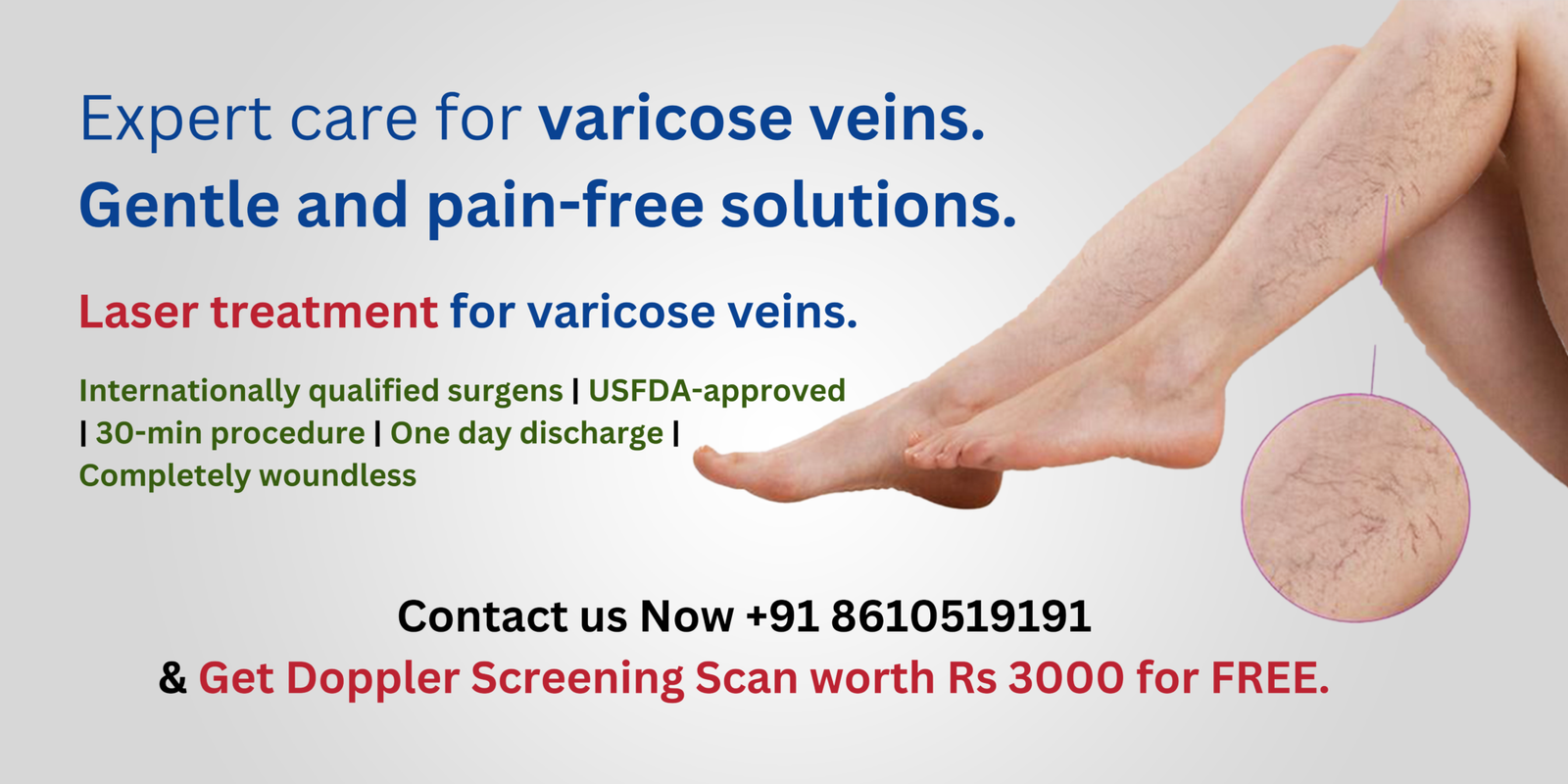 Varicose veins treatment in coimbatore