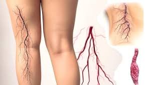 varicose veins treatment